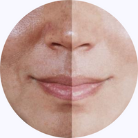 Melasma-products